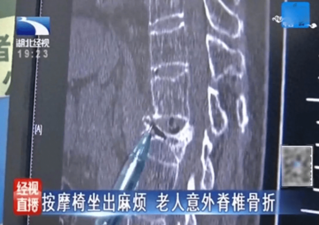 生蟲、卡頭發(fā)、致骨折——共享按摩椅你還敢坐嗎？